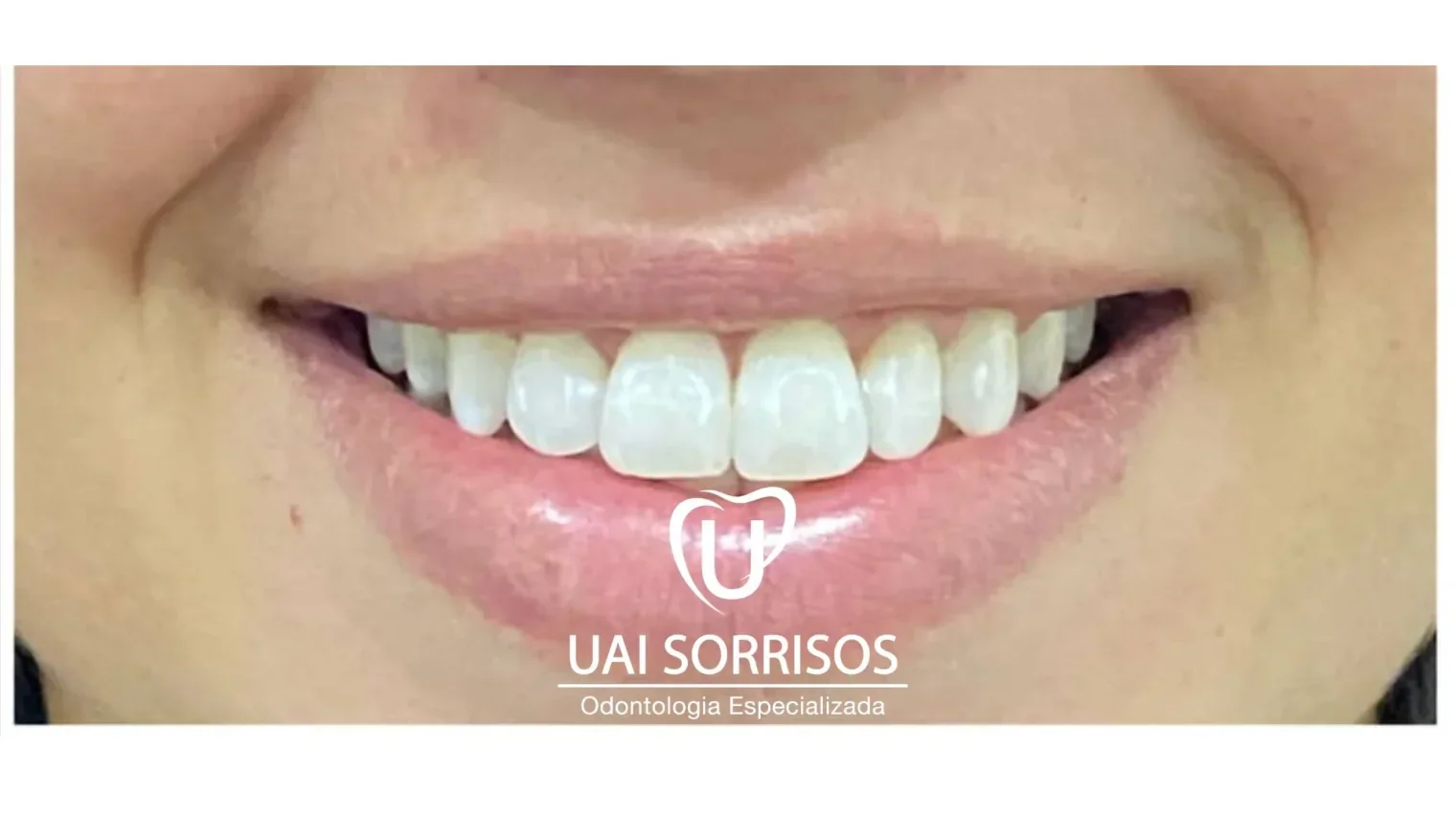 Clareamento Dentário em Itapetininga