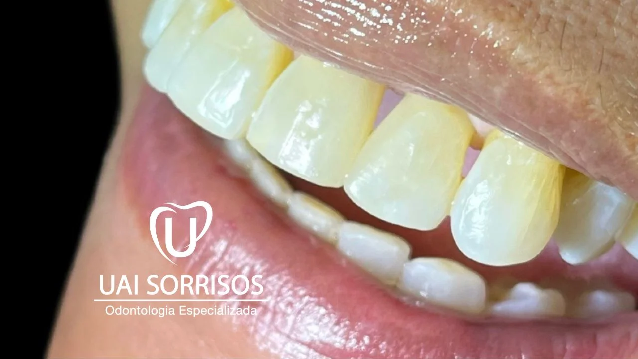 Antes Faceta Resina 2