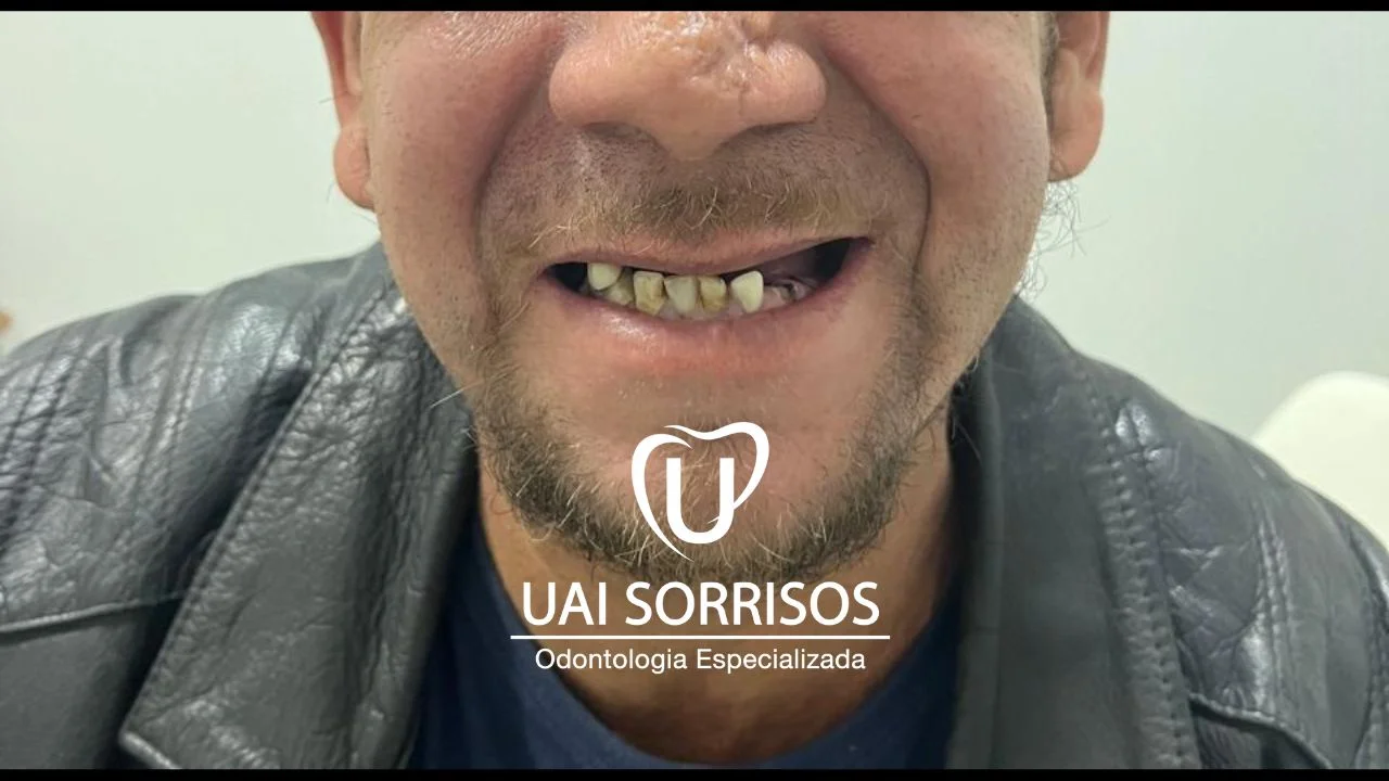 Depois Implante Dentário 1