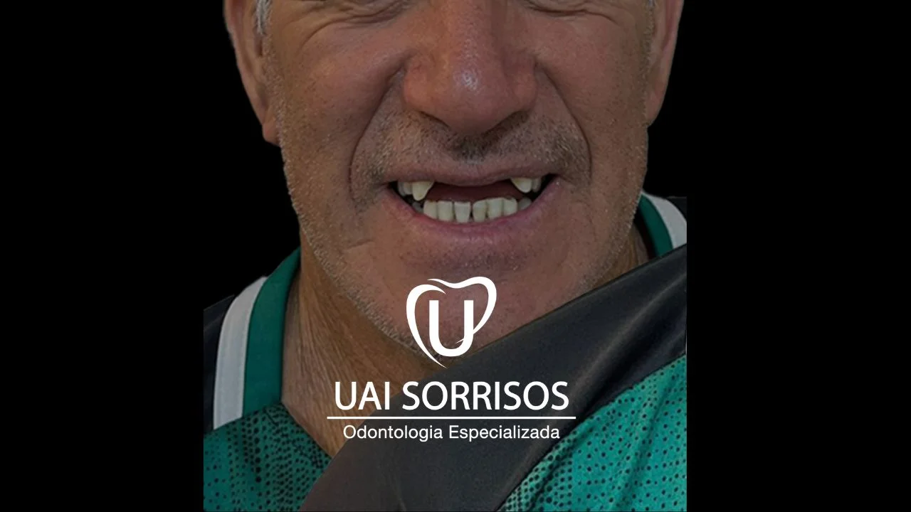 Depois Implante Dentário 2