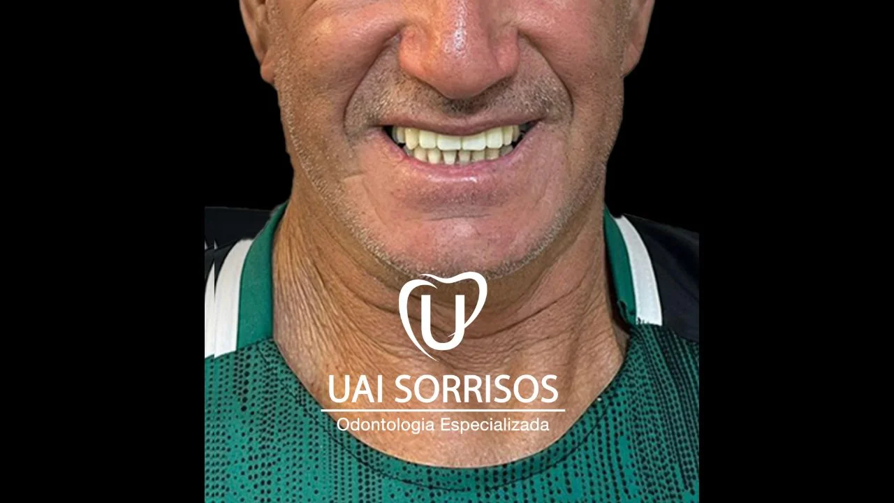 Antes Implante Dentário 2