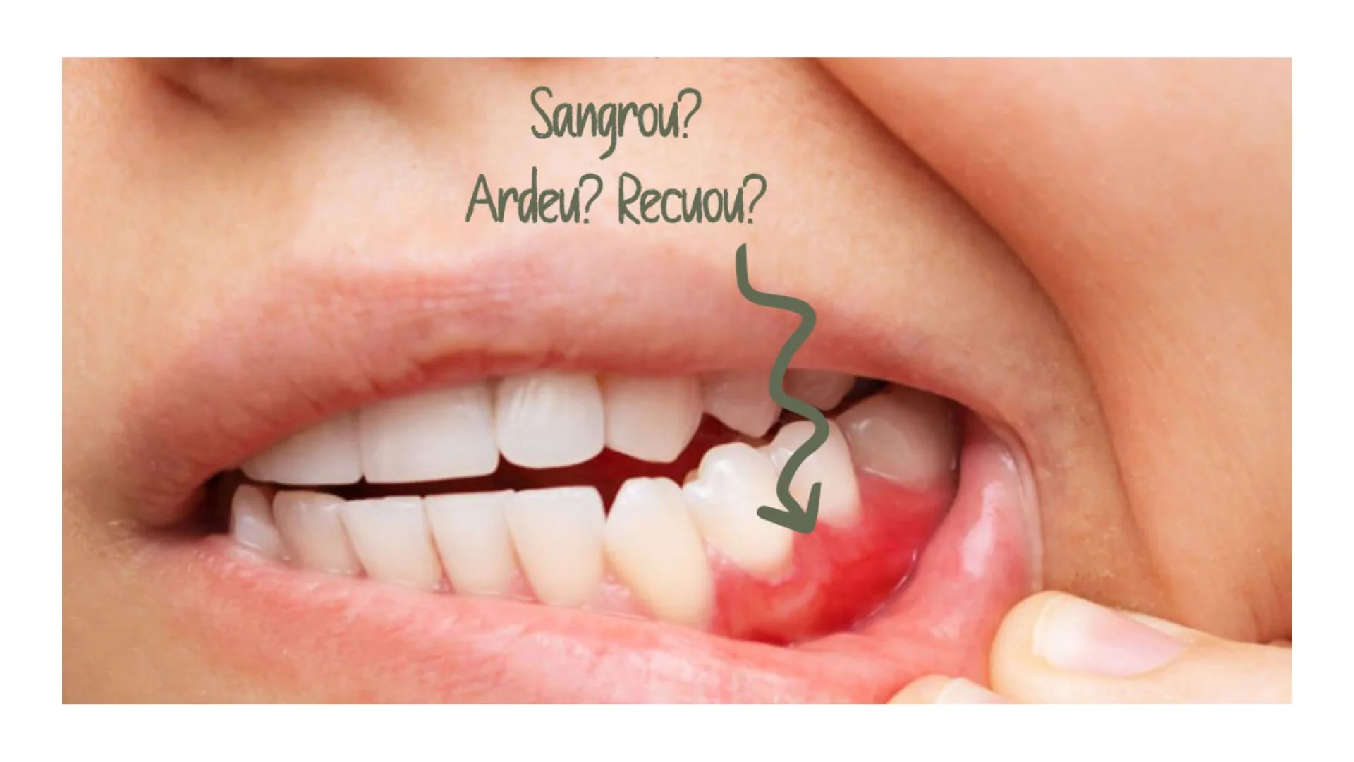 Periodontia - Tratamento de Gengiva